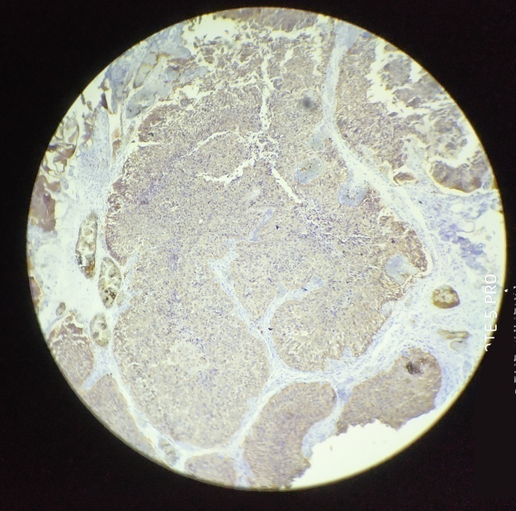 Infiltrating urothelial carcinoma showing positive membranous staining for Her2/neu; IHC; 10x