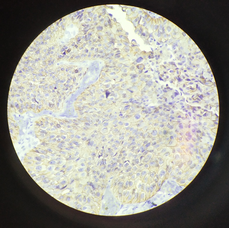 Infiltrating urothelial carcinoma showing positive membranous staining for Her2/neu; IHC; 40x