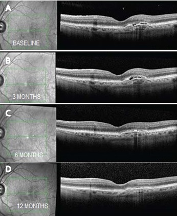 A) Baseline OCT image showing Type 1 active CNVM with sub retinal fluid (SRF). Follow up OCT images showing good response to intravitreal razumab therapy at B) 3 months C) 6 months & D) 12 months with good resolution of SRF