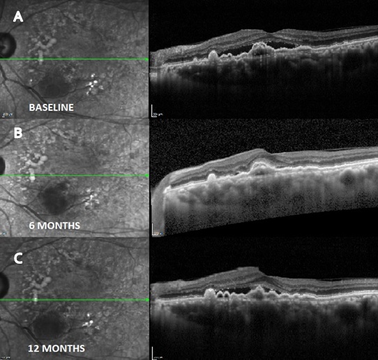 Poor responder to intravitreal razumab therapy; OCT images at A) Baseline showing active CNVM with sub retinal fluid (SRF). B) at 6 months showing good resolution of activity following therapy. C) at 12 months showing reactivation of disease with reappearance of SRF