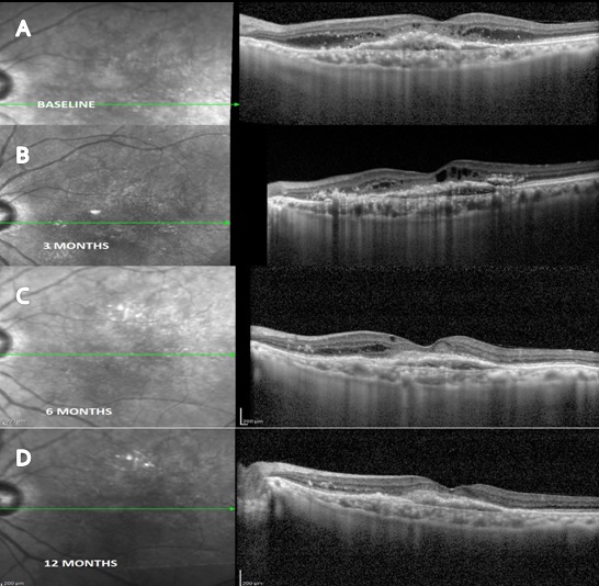 A) Baseline OCT image showing active Type 2 CNVM with Intra retinal fluid (IRF). OCT images following intravitreal lucentis therapy B) at 3 months C) at 6 months D) at 12 months showing good resolution of activity