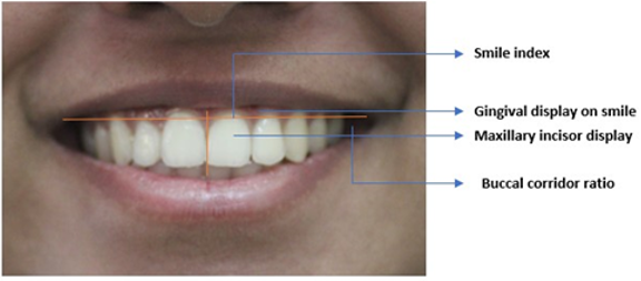 Smile parameters