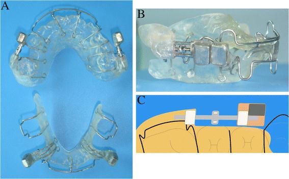 Functional orthopedic magnetic appliance (FOMA)