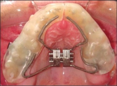 Cap splint appliance 