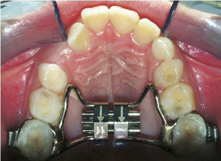 Butterfly expander for use in mixed dentition