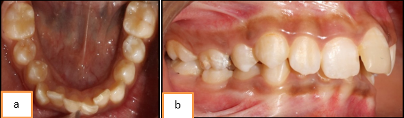 a: Crowding; b: Protrusion
