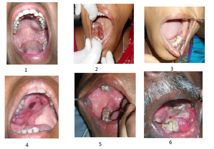 Clinicopathological Insights into Mucoepidermoid Carcinoma: A Retrospective Study from a Dental College Hospital in West Bengal