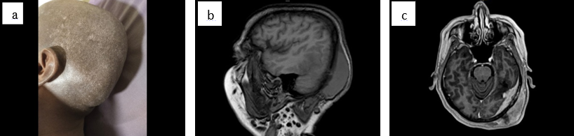 a: pre-op image showing scalp swelling in left parieto occipital region; b: MRI T1WI sagittal image showing isointense scalp swelling; c: MRI contrast showing enhancing lesion arising from left side occipital bone and adjacent dura