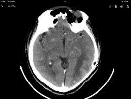 Post op CT brain showing complete excision of lesion