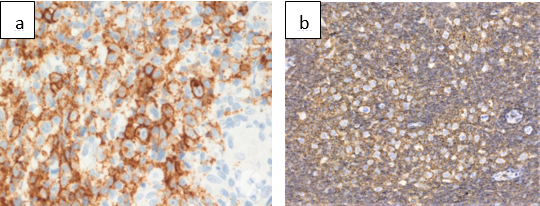 a: IHC positive for CD 20; b: IHC positive for CD 45
