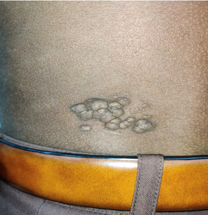 Multiple skin coloured soft nodular growths with comedo like plugs measuring 5 × 4 cm located over left lumbar area. The overlying skin was cerebriform with no ulceration.
