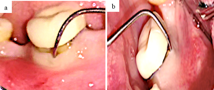 a: Furcation involvement irt 46(buccal); b: Furcation involvement irt 46 (lingual)