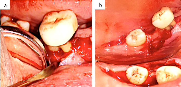 a: Flap reflection (buccal); b: Flap reflection (lingual)
