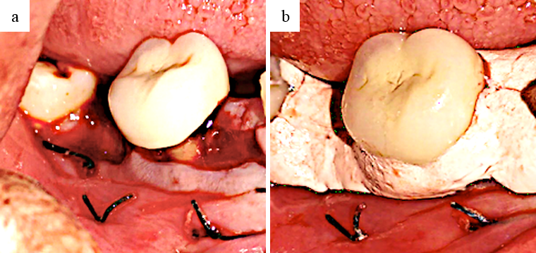a: Sutures placed; b: surgical pack placed
