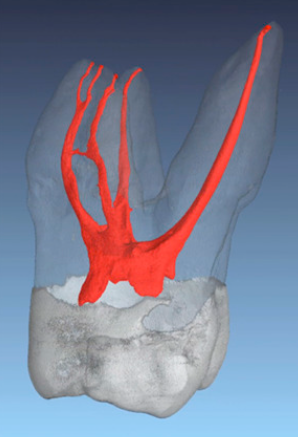 Micro-computed tomography images of an extracted first maxillary first MOLAR: Proximal view - The guidebook to molar endodontics