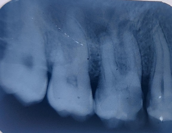 Preoperative intra-oral periapical radiograph of maxillary first molar showing periapical radiolucency at the roots