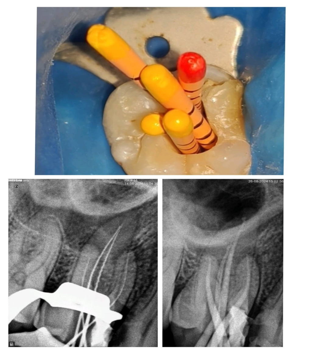 Radiographs of maxillary first molar: Working length determination (before negotiation of MB-2)