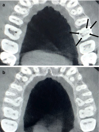 CBCT images: transverse section of maxilla showing maxillary first molar canals; a: At CEJ level; b: At apical third level