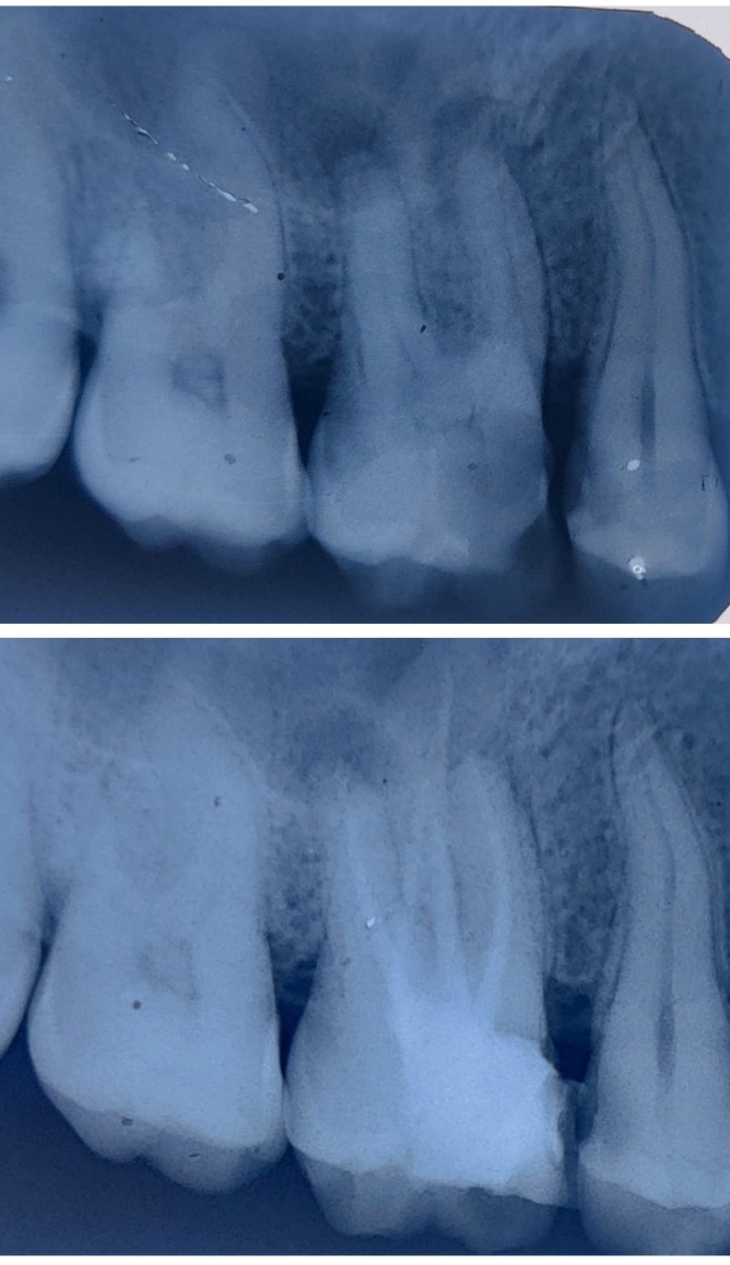 Postoperative intra-oral periapical radiograph of maxillary first molar showing obturation and post endo restoration