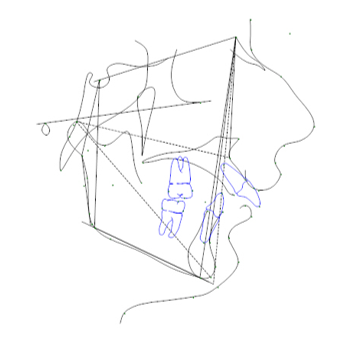 There are 9 craniofacial parameters, which are associated with Golden proportion in ideal human face.