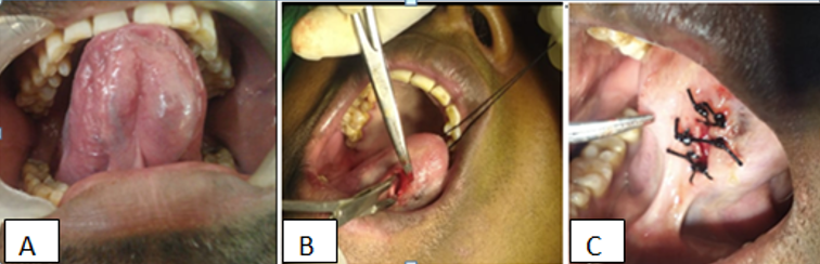A shows swelling on left side ventral surface of tongue, B shows incision on the lesion and C shows postoperative sutured wound.