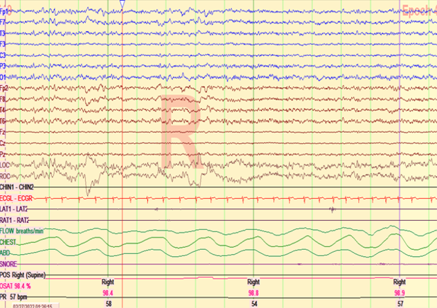 Early SOREMP during nocturnal PSG with extended EEG electrode placement.