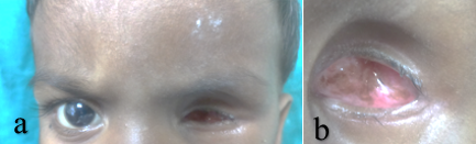 a patient with ocular defect, b ocular bed