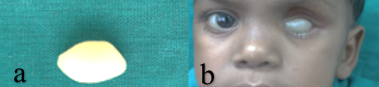 a. Wax pattern for trial, b. Wax pattern tried in patients eye