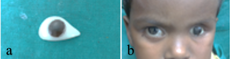 a complete ocular prosthesis, b: final prosthesis tried in patients eye
