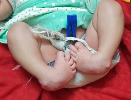 Bilateral idiopathic clubfoot at two weeks of age showing all characteristic deformities