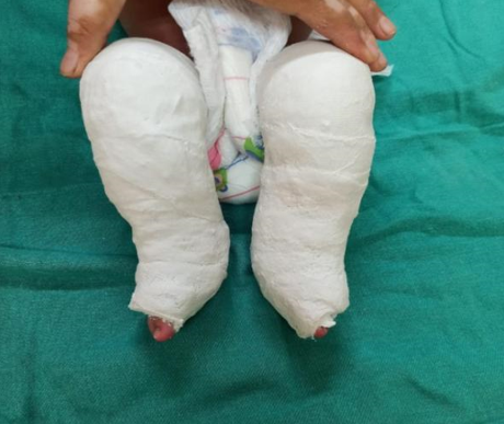 Correction done by serial ponseti casting method