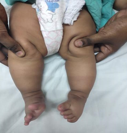 Complete correction of all deformities after five serial Ponseti casts