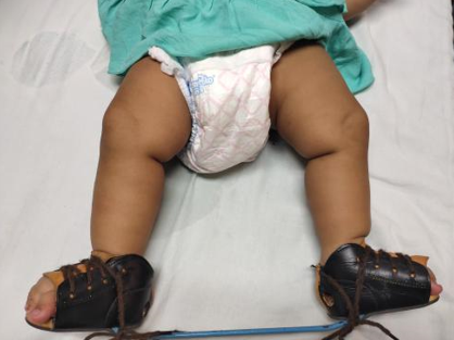 Maintenance of correction by a foot abduction brace