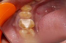 Pre operative