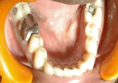 Preoperative with crown