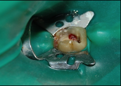 Perforation site with bleeding