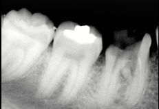 Perforation site sealed with MTA