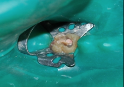 Furcal perforation sealed with MTA