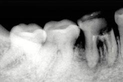 Caries excavation done
