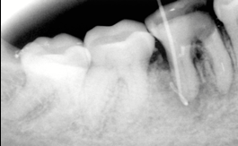 Radiograph showing sinus tracing