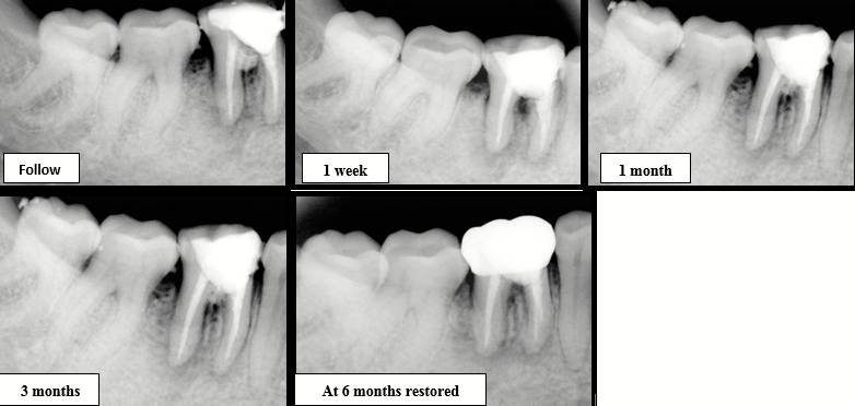 Root canal therapy completed
