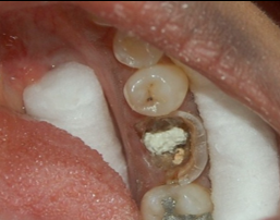 Obturated 36 with extensive caries and furcal perforation