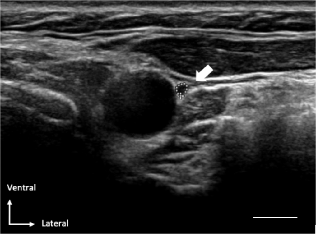 Characteristic illustration of an ultrasound-image in which the VN (with dotted-circle) is located ventro-lateral to the normal carotid-artery. The scale bar equals0.5cm.