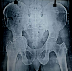 Pre-op