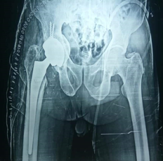Immediate post op