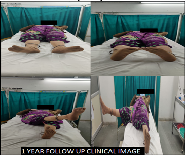 1 Year follow up clinical image
