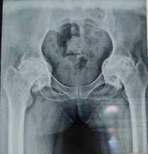 PRE-OP 