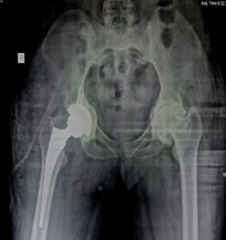 Immediate post op Rt. Side 