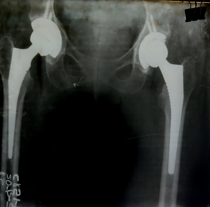 1 year post op