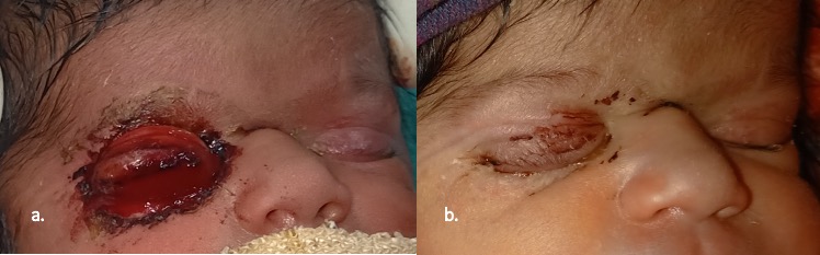 a: Clinical photograph of a 2 days old baby with right upper eyelid total eversion and marked conjunctival chemosis associated with oozing of blood from areas of conjunctival ulcerations. b: Clinical photograph of the same baby at 10 days follow up post conservative management, showing resolution of conjunctival prolapse